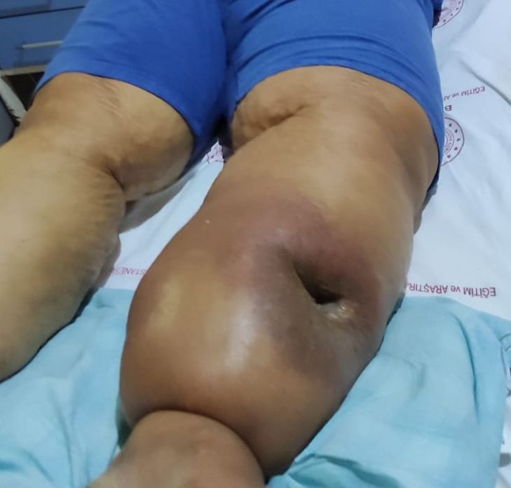 lymphedema due to liver cirrohsis