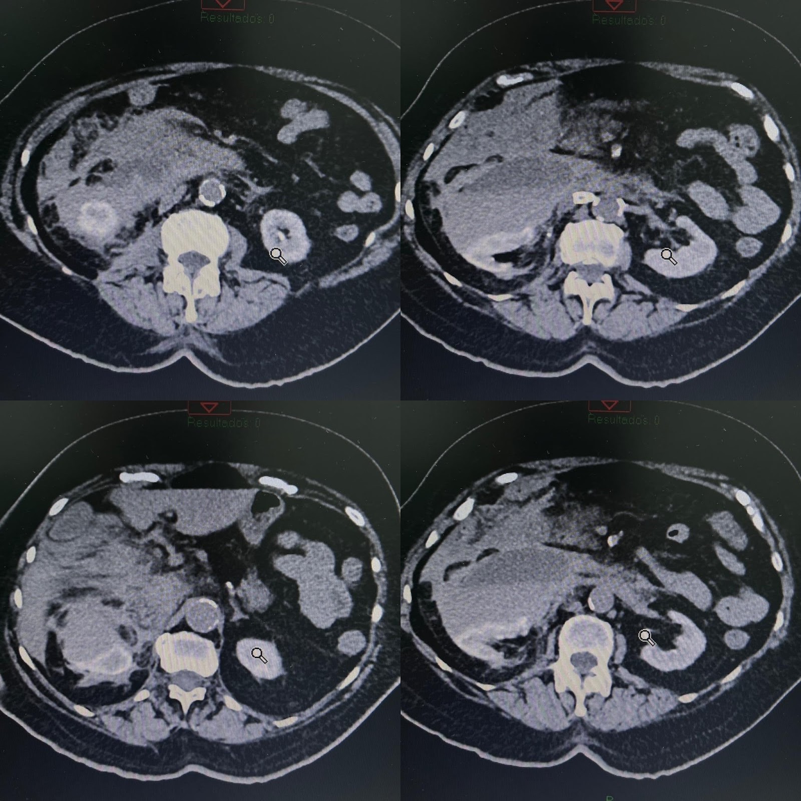 Wunderlich syndrome secondary to renal artery angioplasty