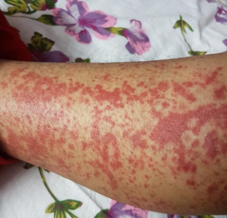 skin-rashes-lupus-like-igE